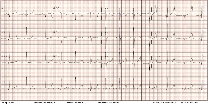 Electrocardiograma de la paciente tras el episodio de p&eacute;rdida de conciencia
