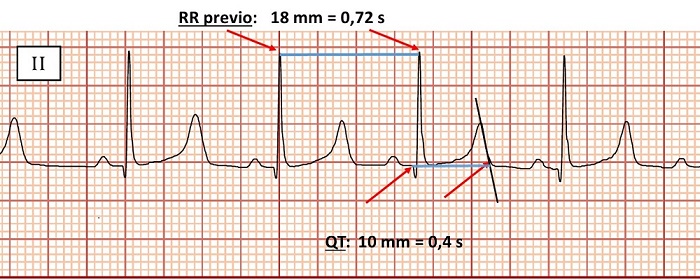 Medici&oacute;n de intervalos QT y RR previo