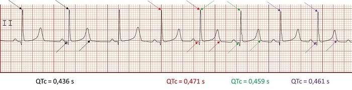 Medici&oacute;n de varios QTc y su media. QTc medio 0,456 s