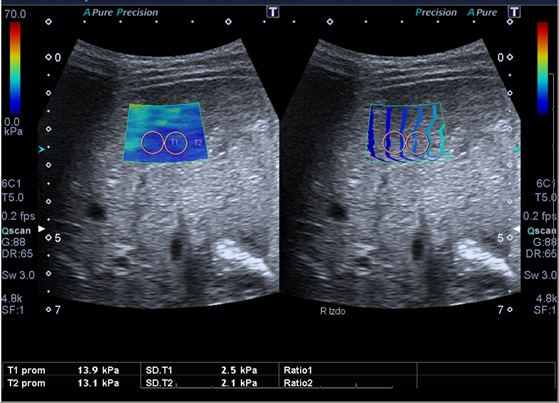 Ecograf&iacute;a con elastograf&iacute;a. La &ldquo;rigidez&rdquo; del h&iacute;gado evaluado se expone a trav&eacute;s de un c&oacute;digo de colores