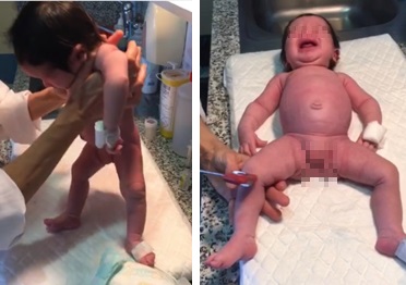 A: hipotonía axial observada con la maniobra de suspensión vertical. B: postura en libro abierto, ausencia de movilidad espontánea de miembros superiores con ROT débiles