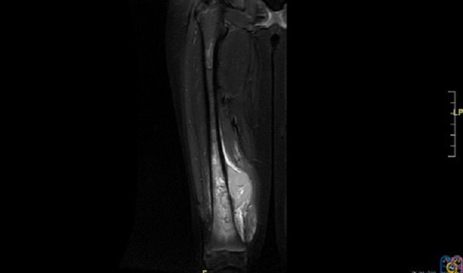 Figura 2. Resonancia magnética. Lesión agresiva medular ósea (10 cm de extensión cráneo-caudal) con masa de partes blandas paraostal (35 × 62 × 42 mm) que sobreeleva el periostio en fémur distal derecho