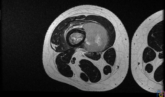 Figura 3. Resonancia magnética. Lesión agresiva medular ósea (10 cm de extensión cráneo-caudal) con masa de partes blandas paraostal (35 × 62 × 42 mm) que sobreeleva el periostio en fémur distal derecho