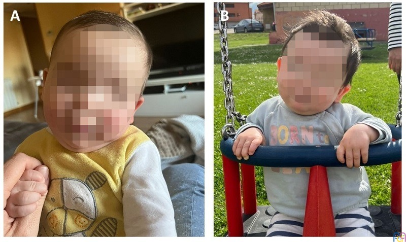 Figura 1. Se observa desviaci�n lateral izquierda de la cabeza con meses de diferencia. (A) 5 meses de vida; (B) 9 meses de vida