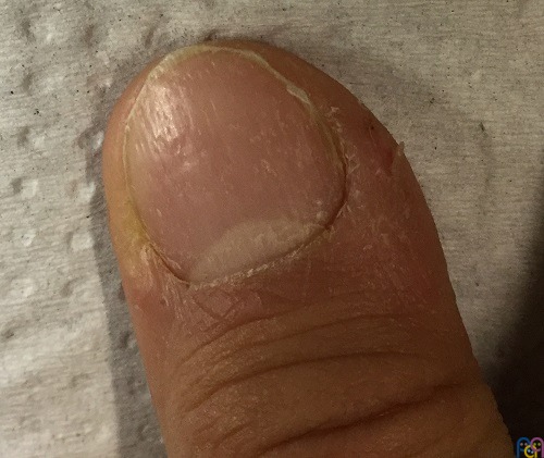 Imagen de u�a del primer dedo, en la que se aprecia la u�a deslustrada, con surcos longitudinales y pitting