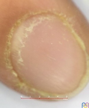 Imagen de la u�a tras tratamiento t�pico corticoideo