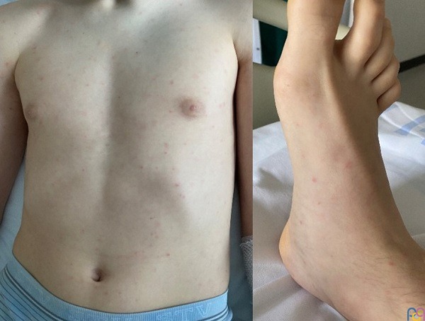 Exantema m�culo-papuloso y eritemato-purp�rico que no desaparece a la digitopresi�n