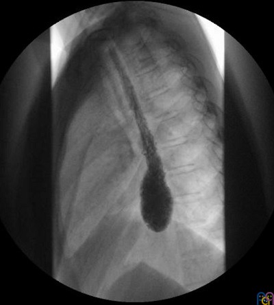 Esofagograma con contraste: dilatación del bolsón distal esofágico con retención de alimentos. No hay paso de contraste a través de la unión esofagogástrica