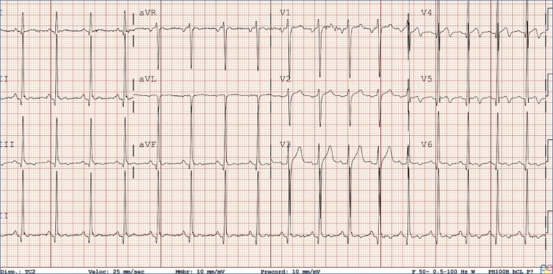 Electrocardiograma en un paciente de 15 a�os con soplo sist�lico eyectivo I/VI en borde esternal izquierdo con 2.� tono normal, con hallazgos sugestivos de hipertrofia ventricular izquierda