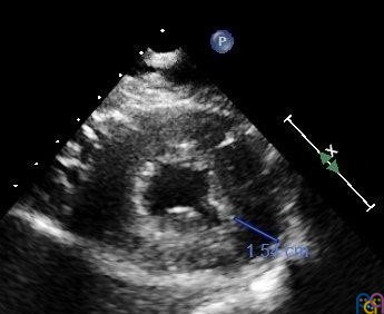 Figura 2. Paciente de 15 a�os con soplo sist�lico eyectivo I/VI en borde esternal izquierdo con 2.� tono normal y hallazgos electrocardiogr�ficos sugestivos de hipertrofia ventricular izquierda. Ecocardiograf�a donde destaca una hipertrofia del ventr�culo izquierdo con espesor de ventr�culo izquierdo aumentado en plano paraesternal eje corto (15 mm)