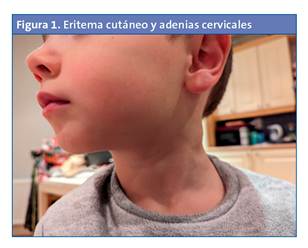Eritema cut�neo y adenias cervicales