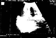 Imagen ecográfica del hematoma subcapsular hepático