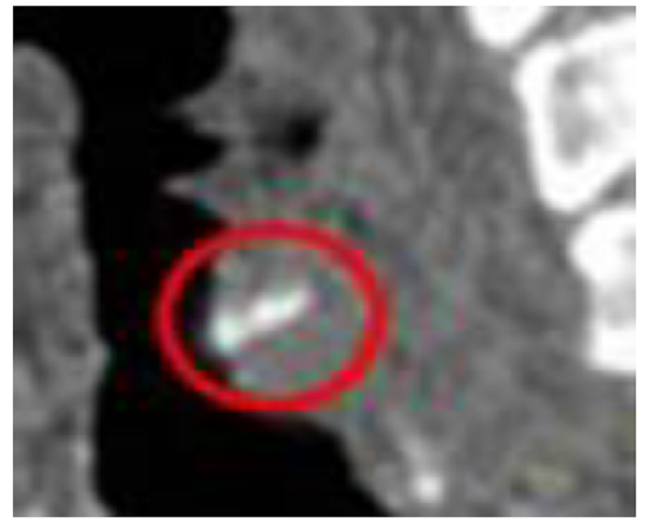 Imagen de resonancia magn&eacute;tica (vista sagital), donde se observa una espina de pescado (c&iacute;rculo rojo)