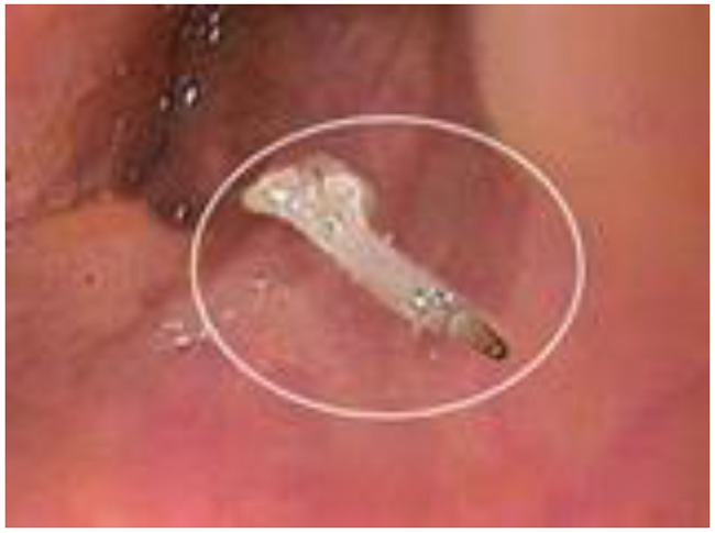 Espina de pescado en la porci&oacute;n cricofar&iacute;ngea (visi&oacute;n endosc&oacute;pica).