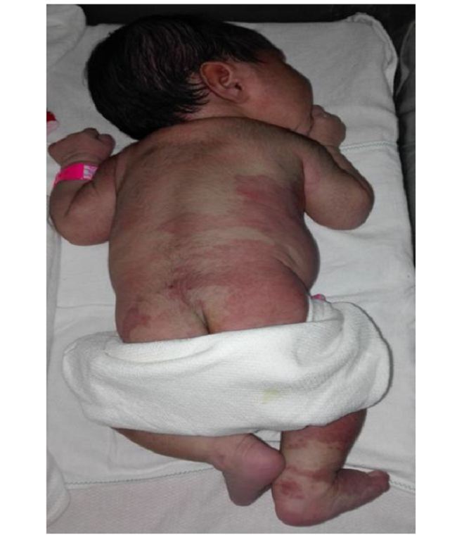 Angiomas cut&aacute;neos en la porci&oacute;n inferior del tronco, el abdomen, la regi&oacute;n gl&uacute;tea y las piernas.