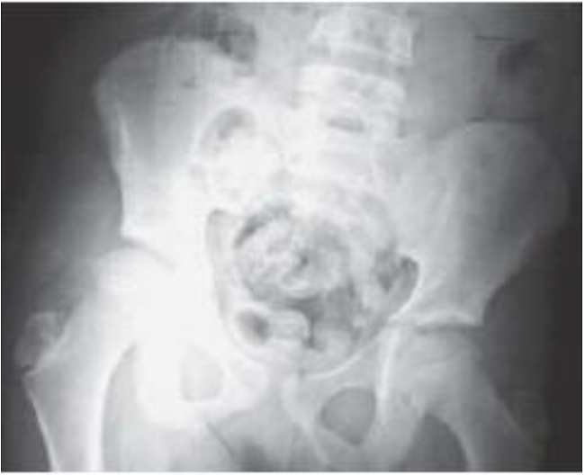 Radiograf&iacute;a anteroposterior de pelvis: diferencia de altura de crestas il&iacute;acas