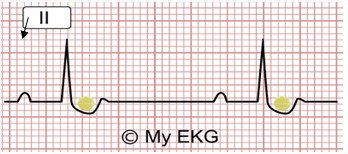 Se muestra el signo electrocardiogr&aacute;fico patognom&oacute;nico de la intoxicaci&oacute;n digit&aacute;lica que, seg&uacute;n los cl&aacute;sicos, puede contener la pastilla de digoxina