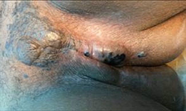 Tumoraci&oacute;n que se extend&iacute;a desde los labios menor y mayor izquierdo hasta el cl&iacute;toris y labio menor derecho.