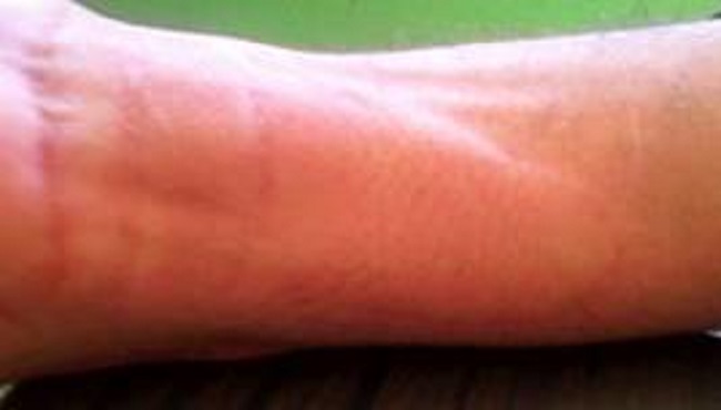 Prueba del cubito de hielo en los primeros 4 minutos de su aplicaci&oacute;n