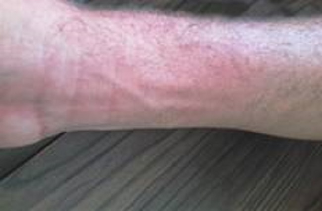 Prueba del cubito de hielo a los 6 meses del tratamiento