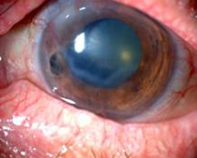 Ojo izquierdo: lesi&oacute;n de c&oacute;rnea con perforaci&oacute;n y hernia del iris