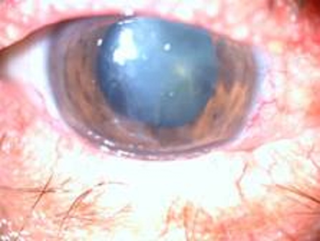 Ojo derecho: lesi&oacute;n extensa de c&oacute;rnea, con perforaci&oacute;n y pigmentos de iris