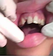 Dientes: corona del 12 con reerupción de 1mm, cambio de color y movilidad de grado II en el 11
