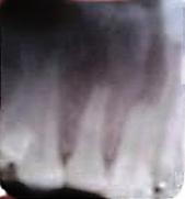 Rayos X periapical en los dientes 11 y 12 que muestra zonas irregulares y radiolúcidas.