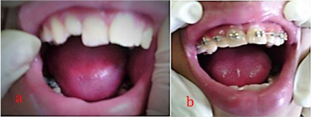 a: Dientes obturados a los 12 meses; b: Aparatología fija a los 23 meses; resalte y sobrepase funcional de los dientes.