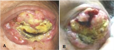 Masa tumoral intraocular en el ojo izquierdo con crecimiento exof&iacute;tico y bordes irregulares