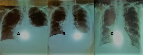 Secuencia de radiografía posterior de tórax