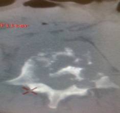 Corte axial de la columna vertebral