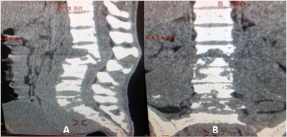 Destrucción vertebral lumbosacra A). Corte sagital; B). Corte coronal