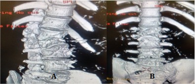 Destrucción vertebral y deformidad raquídea A). Vista oblicua; B). Vista frontal