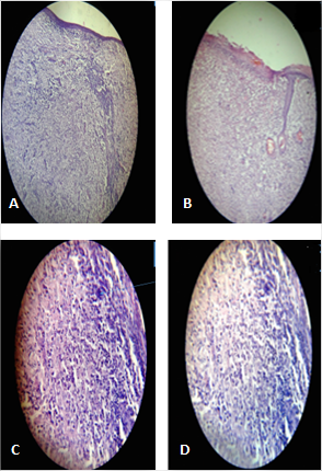 A). Proliferaci&oacute;n celular difusa en la dermis profunda, que rodea los anejos cut&aacute;neos; B) Proliferaci&oacute;n de c&eacute;lulas fusiformes y abundantes c&eacute;lulas claras, con marcada neoformaci&oacute;n vascular y ulceraci&oacute;n de la epidermis; C) Presencia de numerosas c&eacute;lulas espumosas, claras, algunas de ellas gigantes, con atipicidad e hipercrom&iacute;a nuclear; D) Marcada atipicidad de las c&eacute;lulas claras.