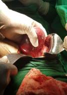 Laxitud del mesenterio 