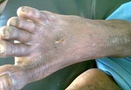 Se muestran signos flog&iacute;sticos en la herida del dorso del pie derecho.