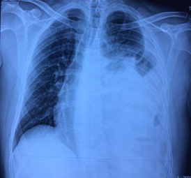 Radiograf&iacute;a de t&oacute;rax con imagen de contenido abdominal en hemit&oacute;rax izquierdo