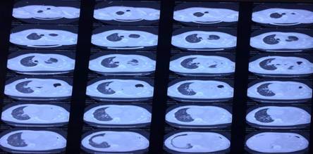 Tomograf&iacute;a axial computarizada simple de t&oacute;rax, donde se observa est&oacute;mago e intestino en hemit&oacute;rax izquierdo.