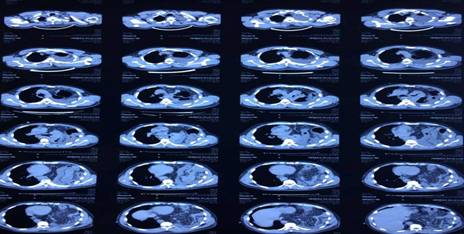 Tomograf&iacute;a de contraste, donde se ratifica la herniaci&oacute;n de los &oacute;rganos abdominales.