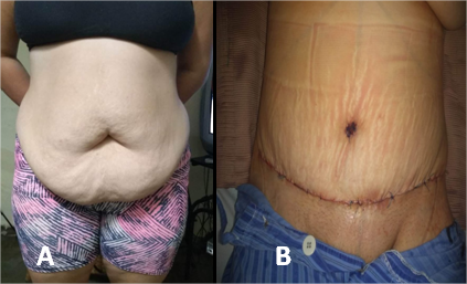 Paciente antes de la intervención quirúrgica; B) después de la operación