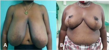 A) Antes de la intervención quirúrgica; B) después de esta.