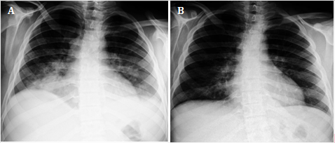 Radiograf&iacute;a posteroanterior de t&oacute;rax del adolescente con COVID-19. A) Al ingreso: radiopacidad no homog&eacute;nea hacia la base del pulm&oacute;n derecho, que oblitera el &aacute;ngulo cardiofr&eacute;nico ipsilateral y borra el contorno anterior de la silueta mediana en estrecha relaci&oacute;n con el cuerno inferior del hilio derecho. Im&aacute;genes radiopacas de aspecto moteado difuso en la regi&oacute;n hiliar y parahiliar izquierda. &Aacute;ngulo costofr&eacute;nico izquierdo borrado. B) A los 7 d&iacute;as: Evidente mejor&iacute;a con respecto al estudio radiol&oacute;gico previo. Solo persiste el infiltrado intersticial en la base del pulm&oacute;n derecho.