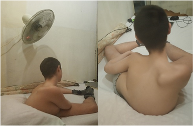 Deformidades musculoesqueléticas