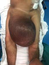 Paciente con hernia inguinal gigante