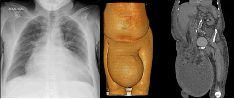 Radiograf&iacute;a de t&oacute;rax y tomograf&iacute;a computarizada donde se observa reconstrucci&oacute;n y hallazgos previamente descritos.