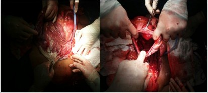 Saco herniario y apertura de este con asas intestinales en su interior