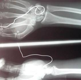 Imagen radiogr&aacute;fica. Observe el recorrido del alambr&oacute;n 