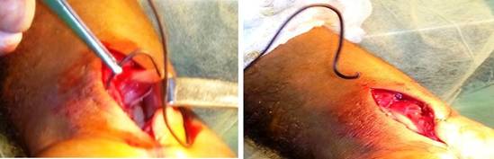 Extracci&oacute;n del alambr&oacute;n