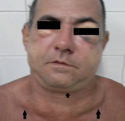 Paciente con edema infraorbitario derecho, periorbitario izquierdo, hematoma en su p&aacute;rpado inferior y medial, as&iacute; como edema a nivel cervical del cuello y superior